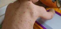 ÎNCOTRO? Cea mai mare epidemie de rujeolă din ultimii ani ÎNCOTRO? Cea mai mare epidemie de rujeolă din ultimii ani