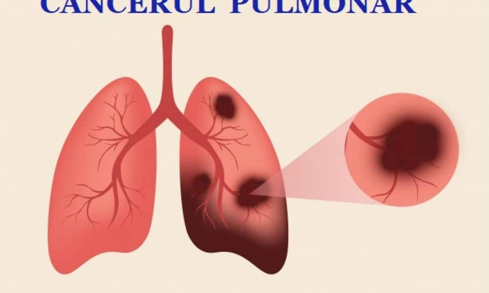 Cercetătorii din China dezvoltă un senzor care detectează cancerul pulmonar cu o precizie remarcabilă