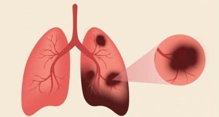 Cercetătorii din China dezvoltă un senzor care detectează cancerul pulmonar cu o precizie remarcabilă