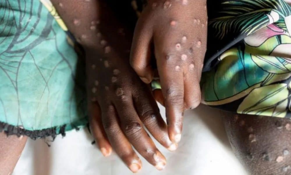 Noi cazuri de infecţie cu varianta mai periculoasă de mpox. Care sunt ţările care au confirmat îmbolnăviri